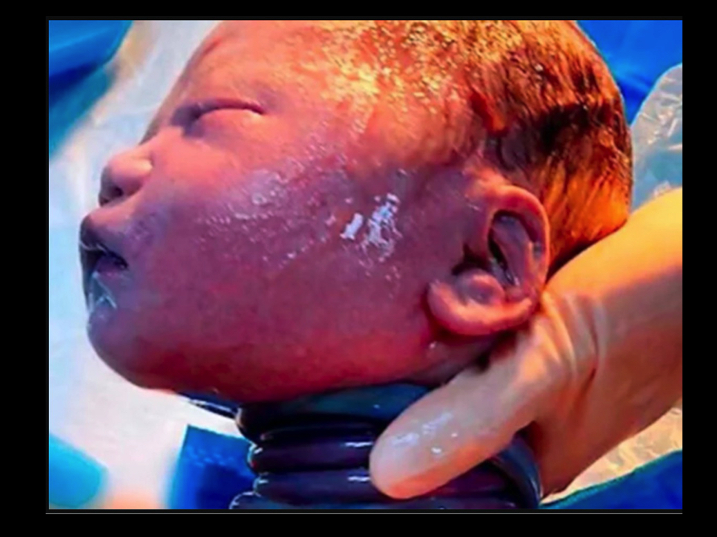 arenagempak.com - Bayi Dilahirkan Dengan Leher Terbelit Tali Pusat Seperti Ular