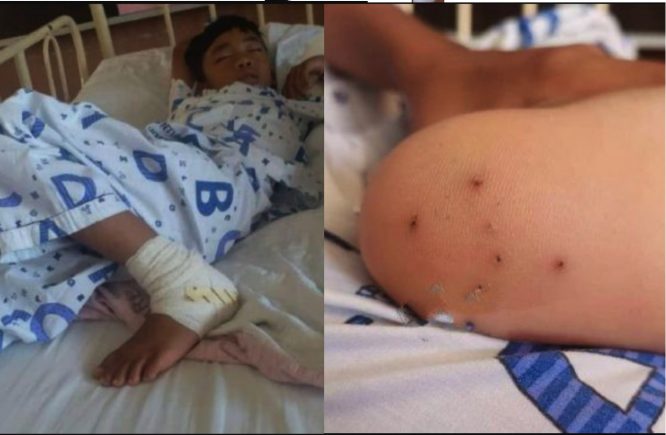 arenagempak.com - Anak Menjerit Merengek Sakit, Duri Landak Di Tumit Kaki Dan Terpaksa Bawa Ke Hospital