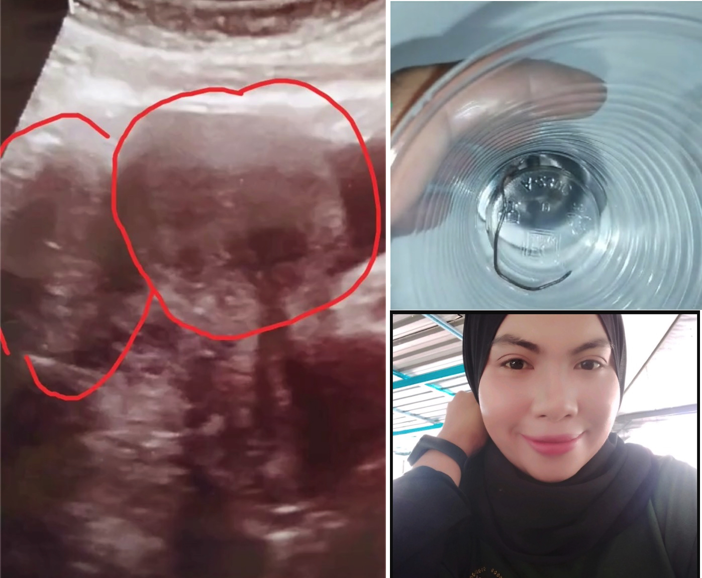 Perut Bergerak-gerak Disangkakan Hamil, Wanita Terkejut Bila Scan Nampak 4 Ekor Anak Ular