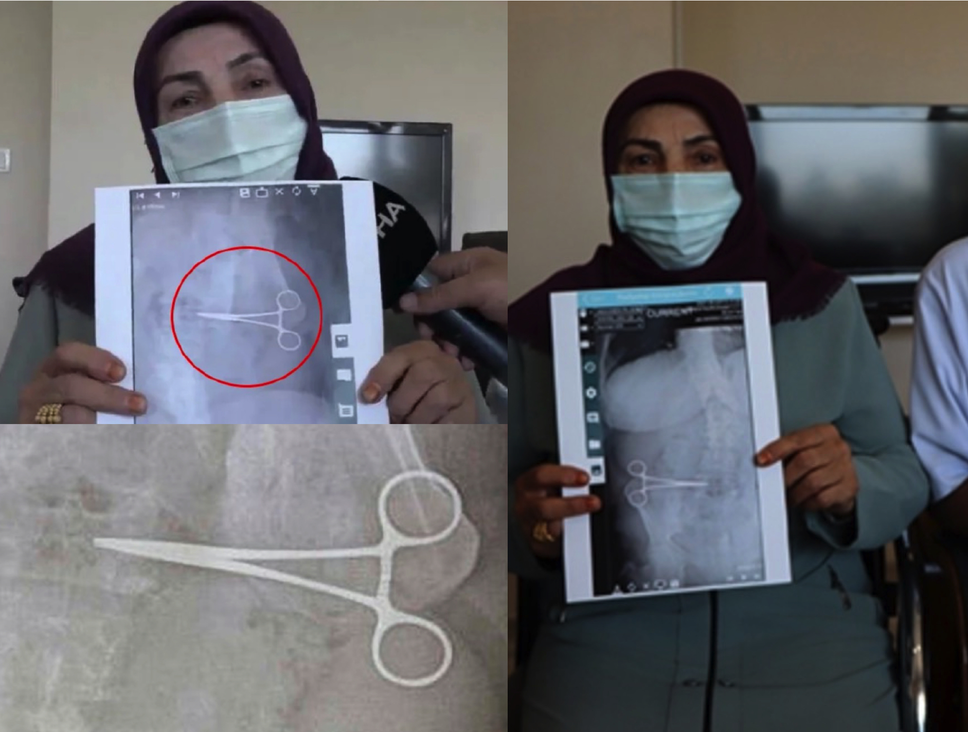 Doktor Kata Sakit Normal Selepas Pembedahan, Wanita Jumpa Doktor Lain Dan Terkejut Gunting Ditemui Dalam Perutnya