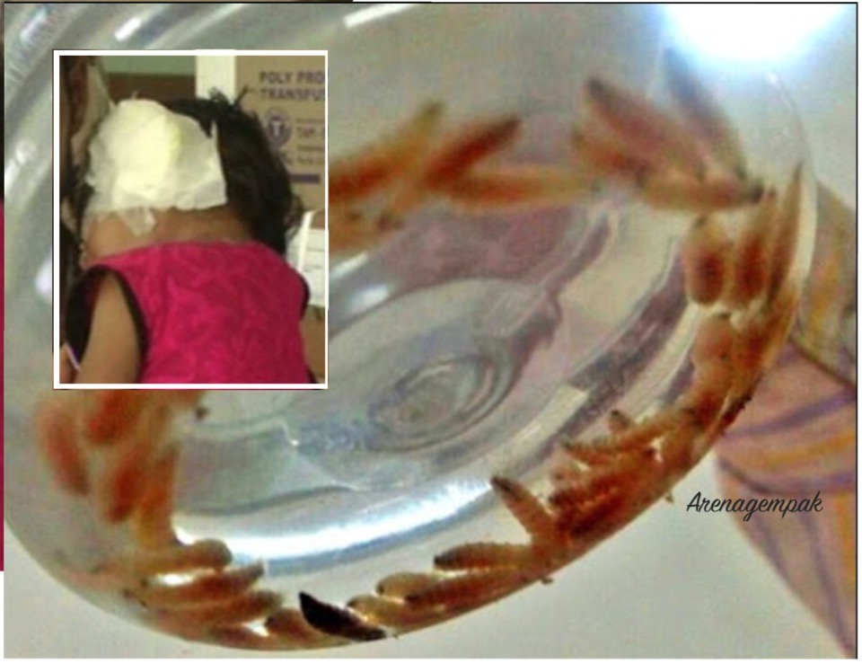 Kanak-kanak Perempuan Mengadu Sakit Dan Gatal Di Telinga, Doktor Terkejut Menemui 80 Ekor Ulat Dalam Telinganya
