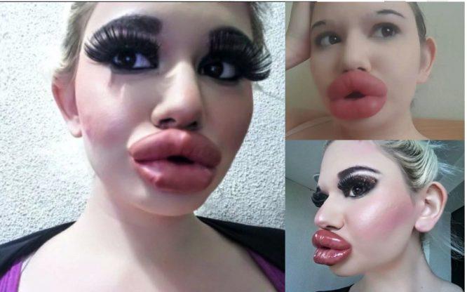 Wanita Memiliki Bibir Terbesar Di Dunia Masih Obses Meskipun Doktor Beri Amaran Agar Berhenti Membesarkan Bibirnya